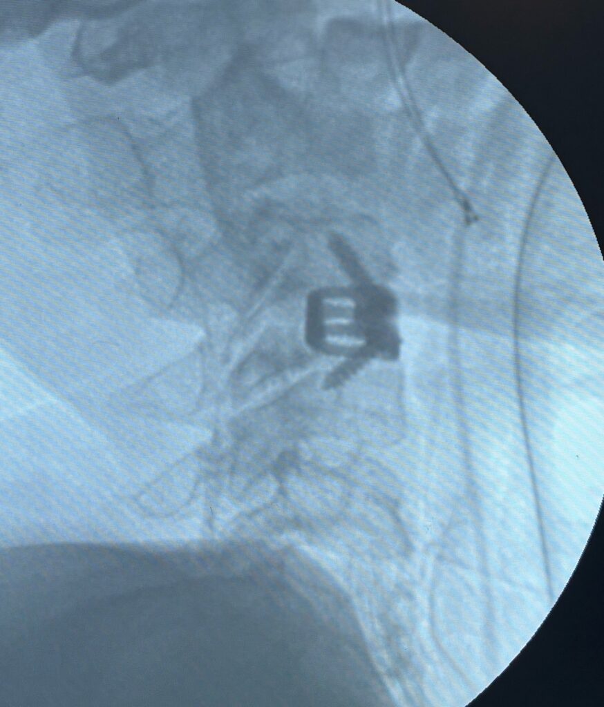 Cervicothoracic pedicle screw fixation in junctional trauma