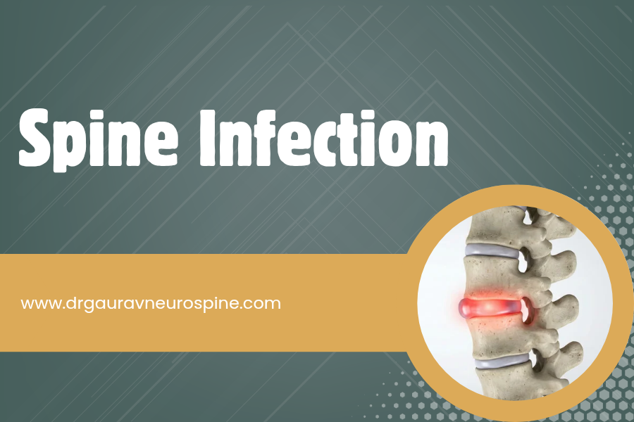 Spine infection treatment in Udaipur
