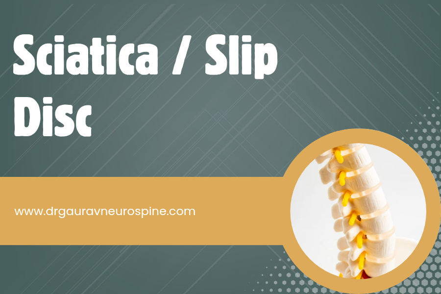 Sciatica, Slip Disc treatment in Udaipur