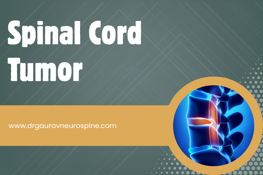 Spinal cord tumor treatment in udaipur