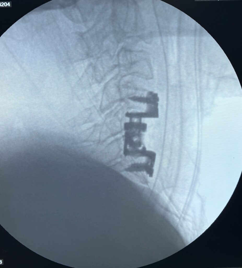 Cervical corpectomy using expandable titanium cage