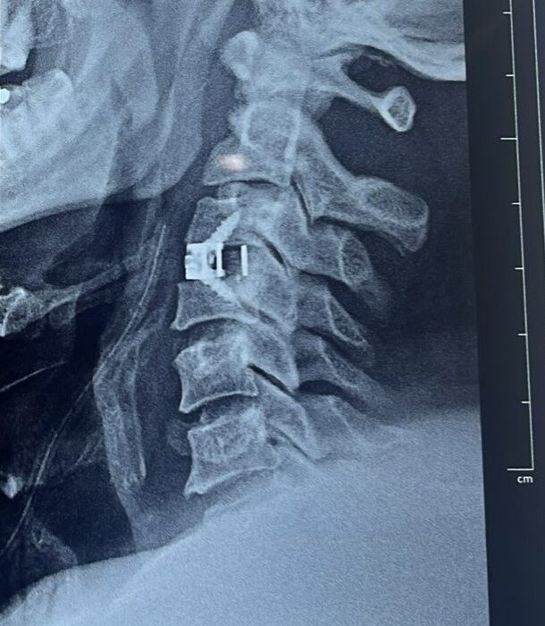 anterior cervical discectomy using PEEK Cage