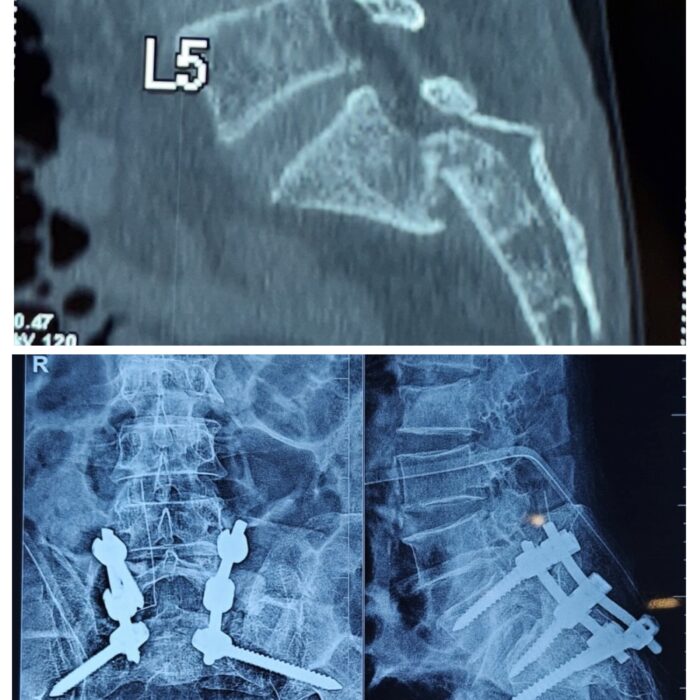 Cervicothoracic pedicle screw fixation in junctional trauma