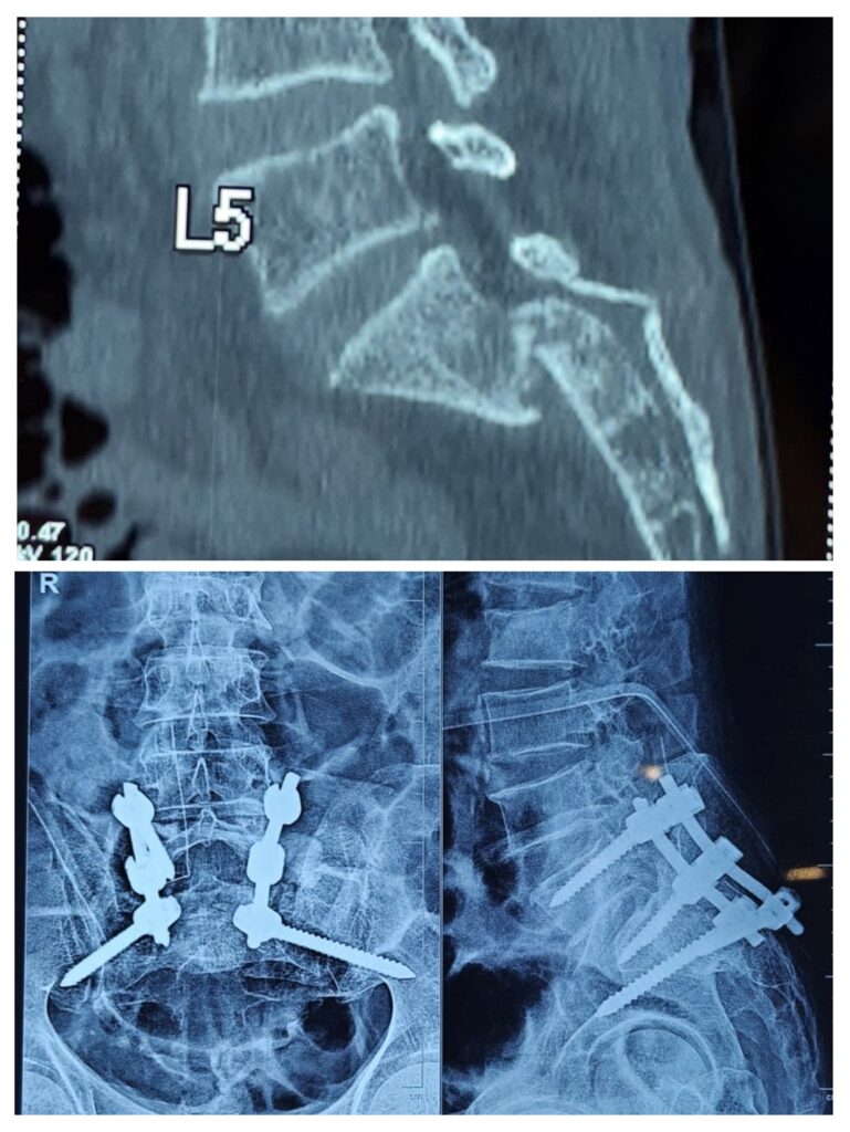 Cervicothoracic pedicle screw fixation in junctional trauma