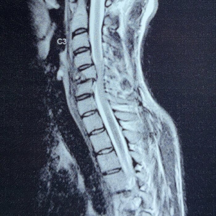 Cervical corpectomy using titanium expandable cage with plate in post traumatic C5 fracture