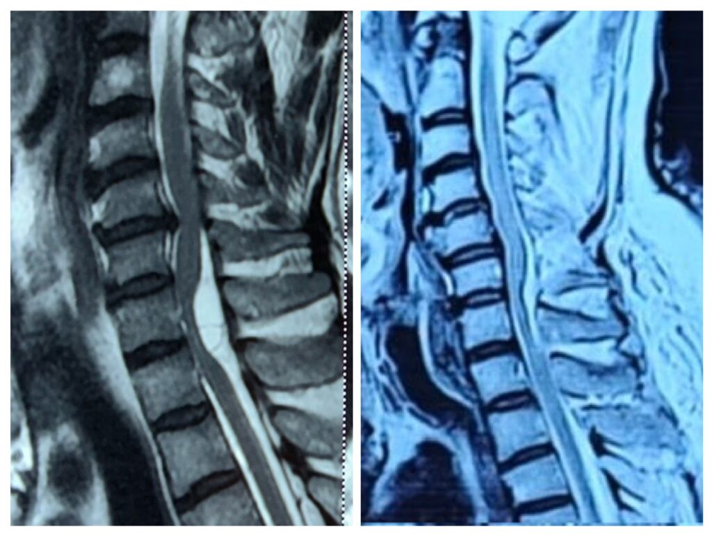 Spine cord tumor treatment