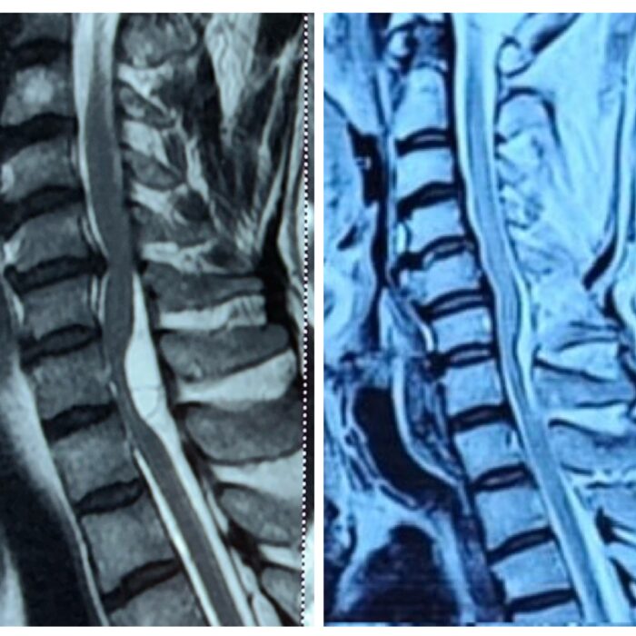 Spine cord tumor treatment