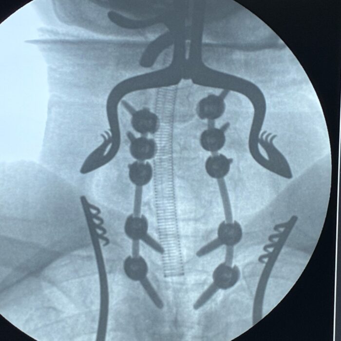 C7 metastatic tumor with canal compromise