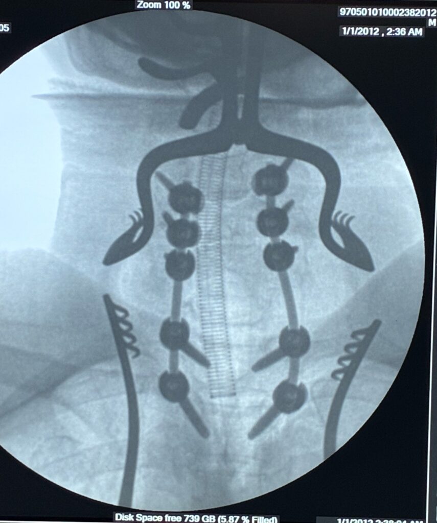 C7 metastatic tumor with canal compromise