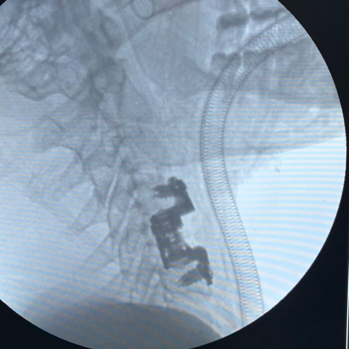 Cervical corpectomy using titanium expandable cage with plate in post traumatic C5 fracture