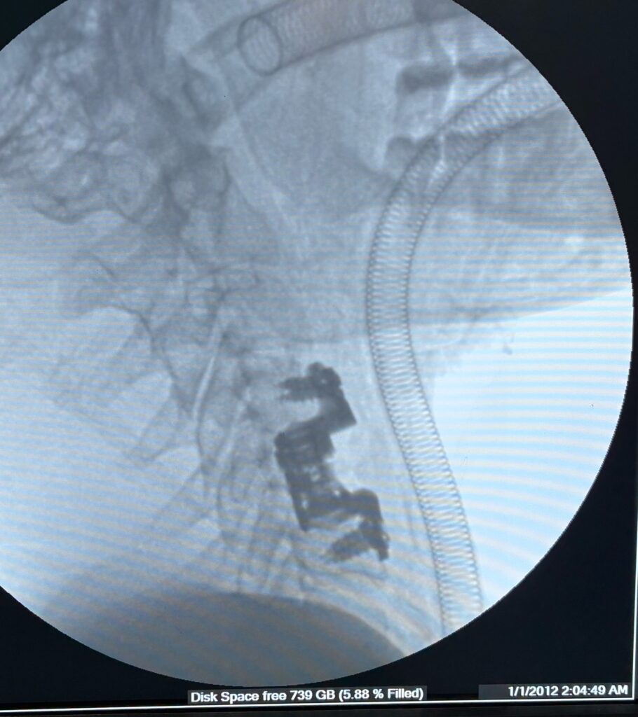 Cervical corpectomy using titanium expandable cage with plate in post traumatic C5 fracture