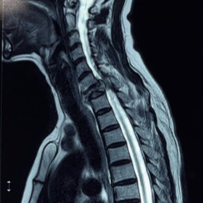 C7 metastatic tumor with canal compromise