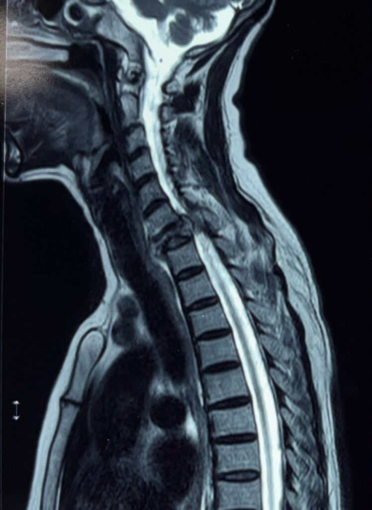 C7 metastatic tumor with canal compromise