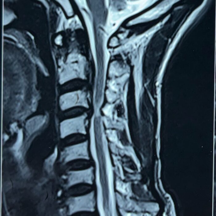 Anterior cervical discectomy and fusion using titanium cage 1