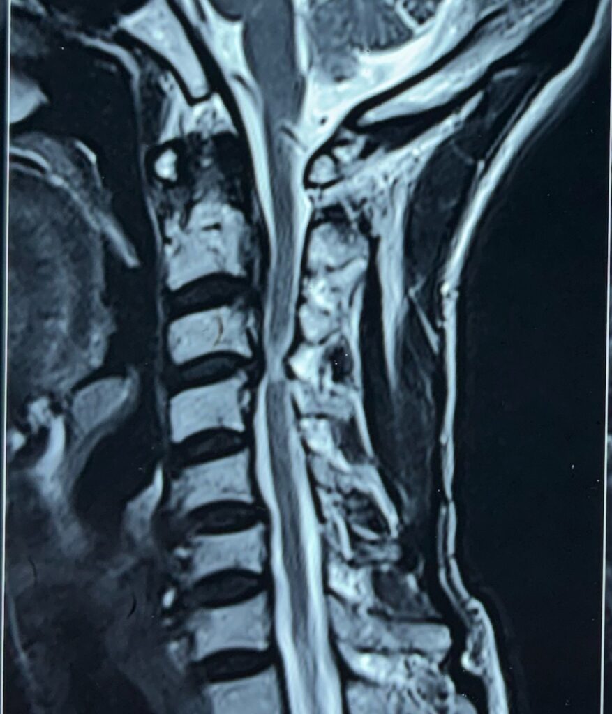Anterior cervical discectomy and fusion using titanium cage 1