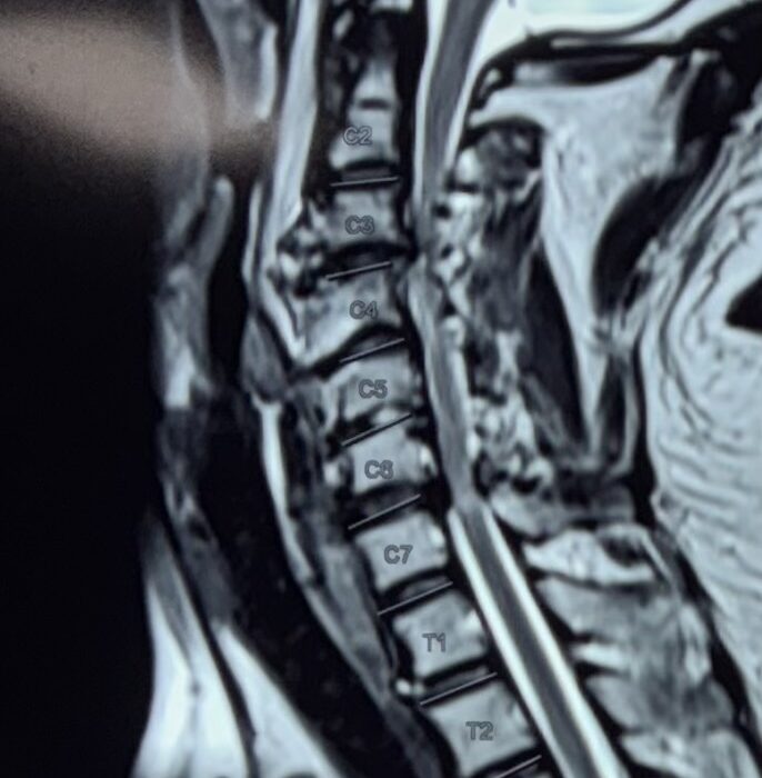 cervical pedicle screw fixation