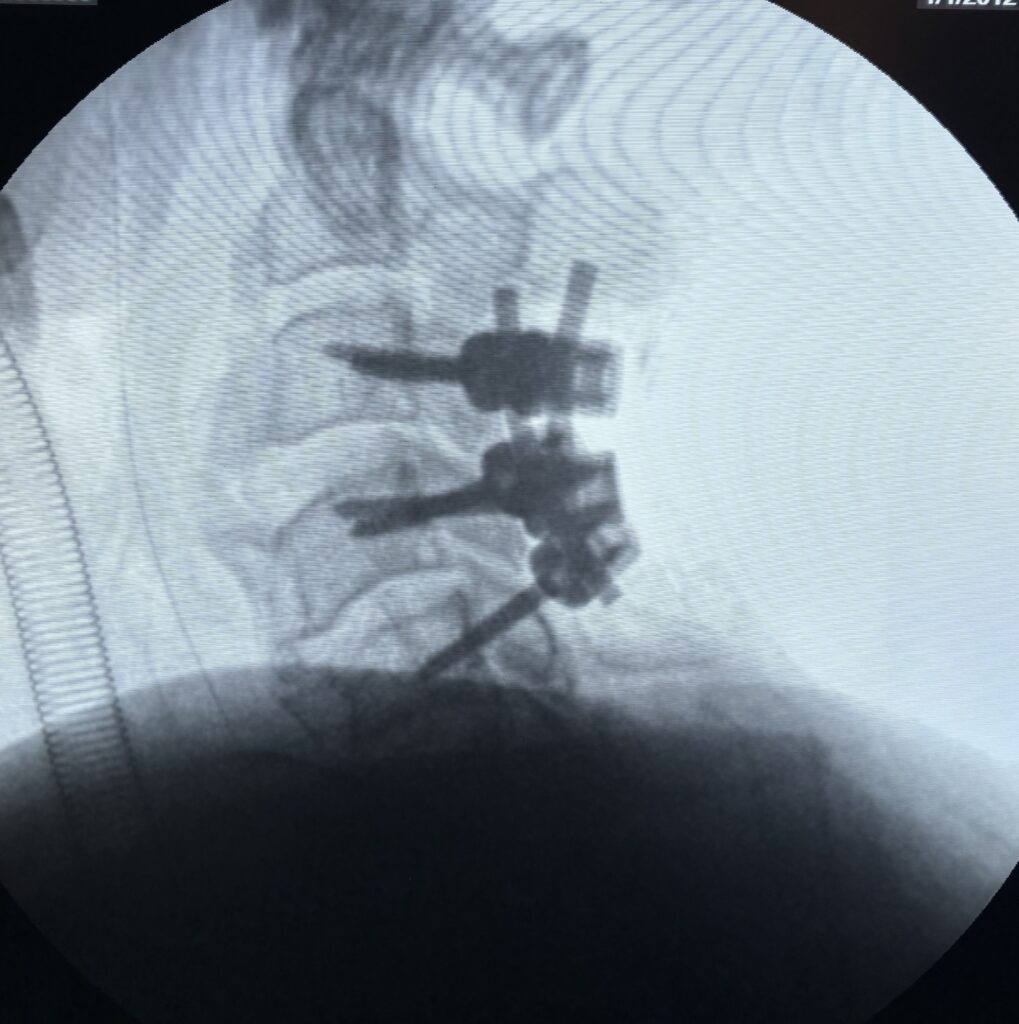 cervical pedicle screw fixation